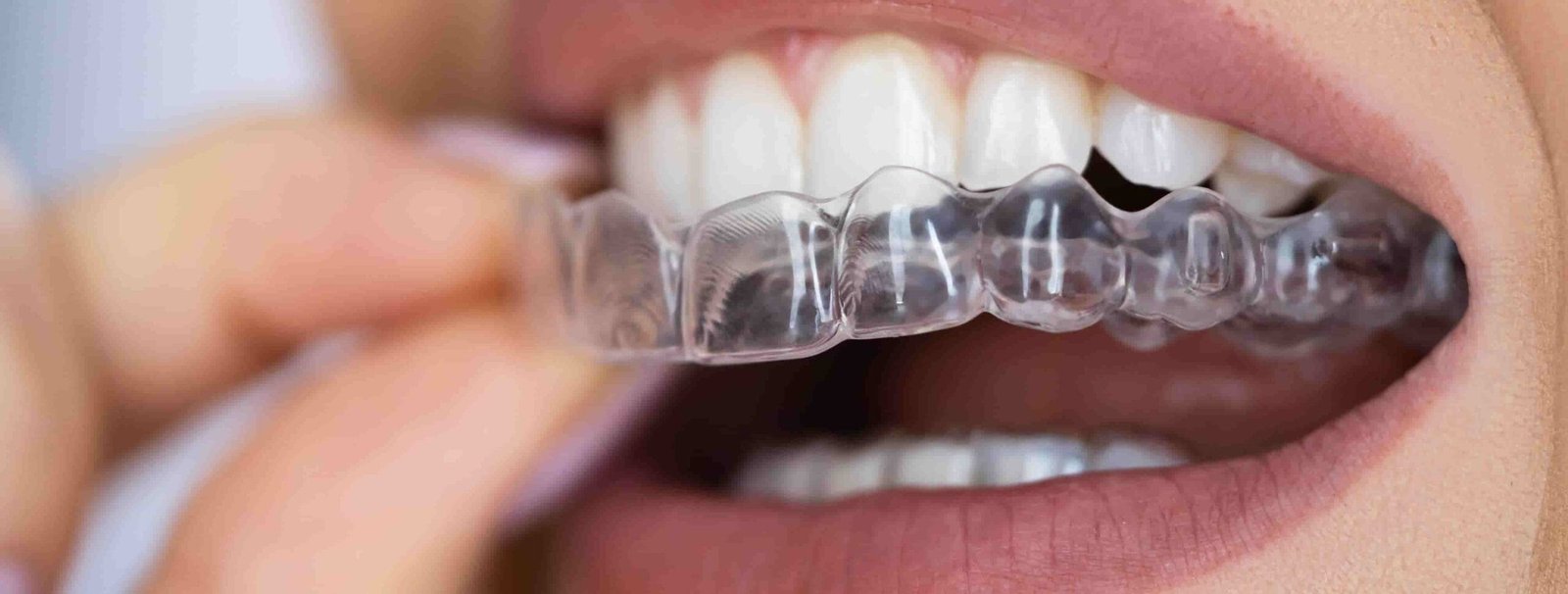 Clear aligner being placed over teeth