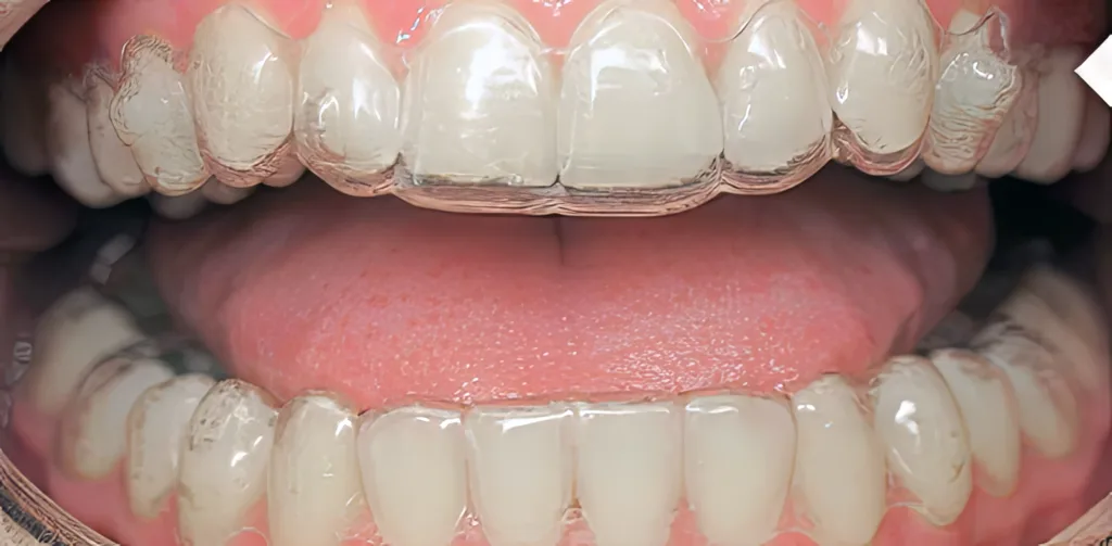 Current instructions image showing aligner tracking examples