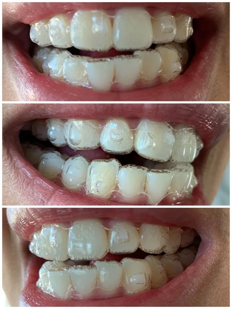 Examples of the front, right-side, and left-side photographs needed to show aligner fit